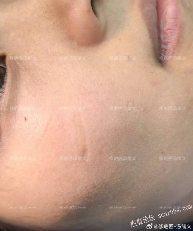 疤痕修复术后即刻