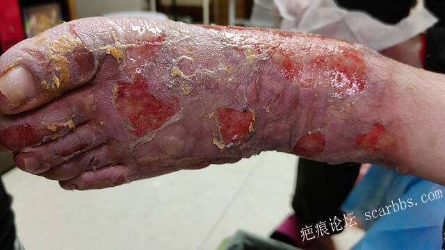 李高令2026年，接治又一个黑龙江哈尔滨，51岁，下肢瘫痪的病人… 