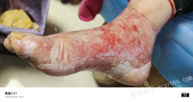 李高令2026年，接治又一个黑龙江哈尔滨，51岁，下肢瘫痪的病人… 