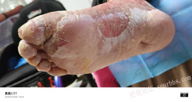 李高令2026年，接治又一个黑龙江哈尔滨，51岁，下肢瘫痪的病人… 