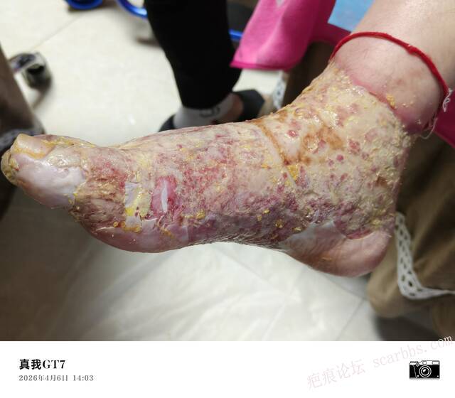 李高令2026年，接治又一个黑龙江哈尔滨，51岁，下肢瘫痪的病人… 