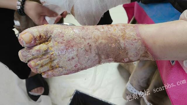 李高令2026年，接治又一个黑龙江哈尔滨，51岁，下肢瘫痪的病人… 