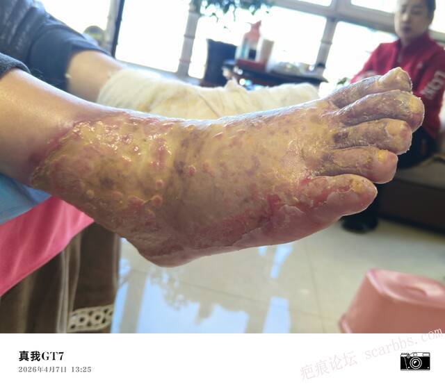 李高令2026年，接治又一个黑龙江哈尔滨，51岁，下肢瘫痪的病人… 