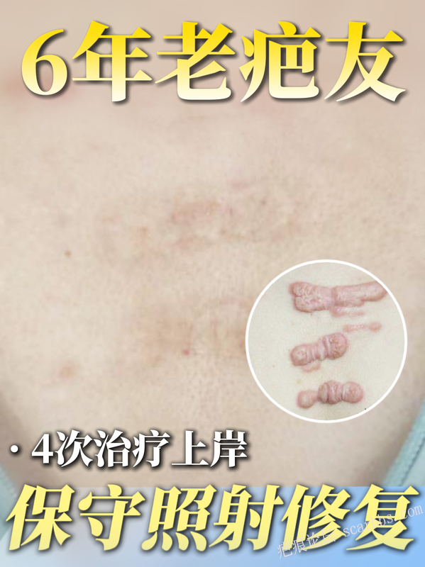 治愈6年复查|大面积疤痕疙瘩也能保守治疗