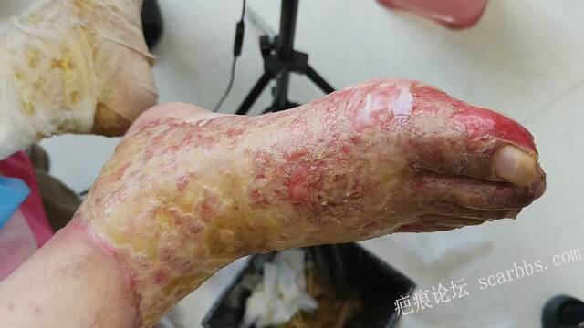 李高令2026年，接治又一个黑龙江哈尔滨，51岁，下肢瘫痪的病人… 