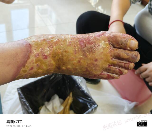 李高令2026年，接治又一个黑龙江哈尔滨，51岁，下肢瘫痪的病人… 