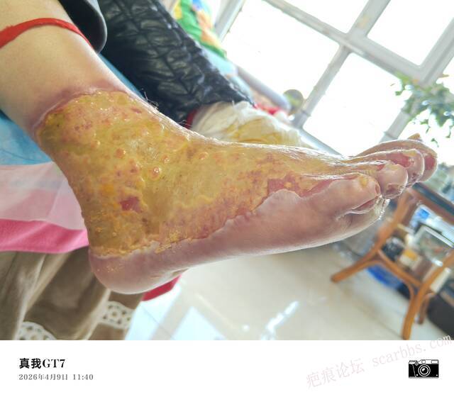 李高令2026年，接治又一个黑龙江哈尔滨，51岁，下肢瘫痪的病人… 