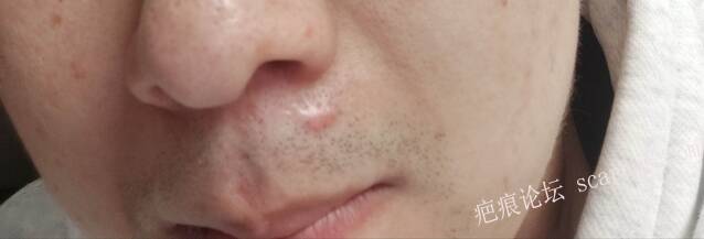 面部手术缝针疤痕