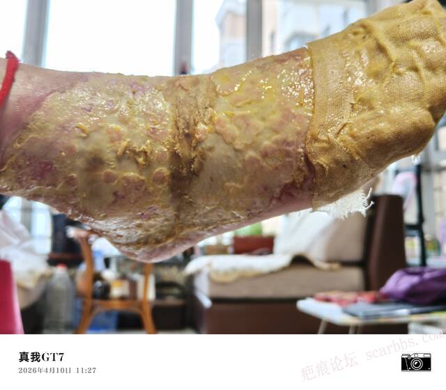 李高令2026年，接治又一个黑龙江哈尔滨，51岁，下肢瘫痪的病人… 