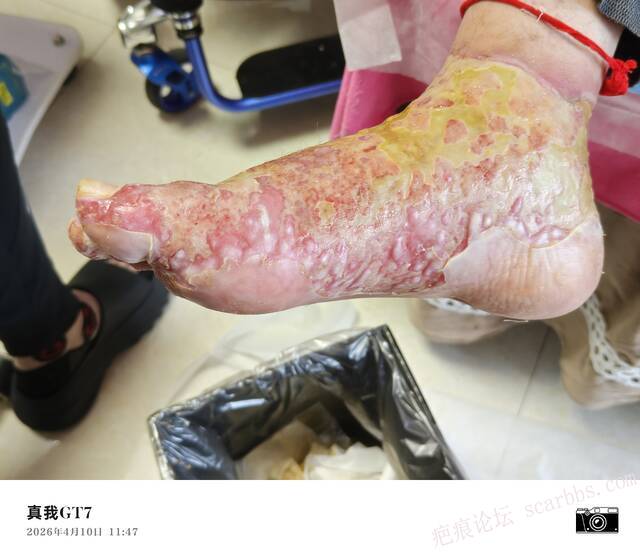 李高令2026年，接治又一个黑龙江哈尔滨，51岁，下肢瘫痪的病人… 