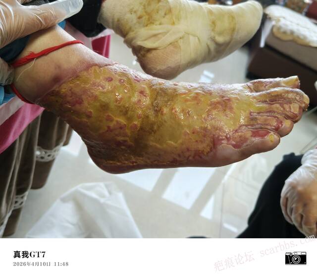 李高令2026年，接治又一个黑龙江哈尔滨，51岁，下肢瘫痪的病人… 