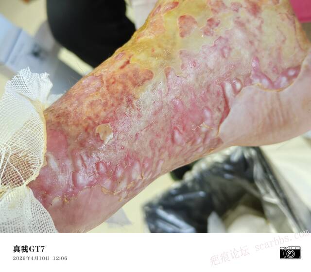 李高令2026年，接治又一个黑龙江哈尔滨，51岁，下肢瘫痪的病人… 