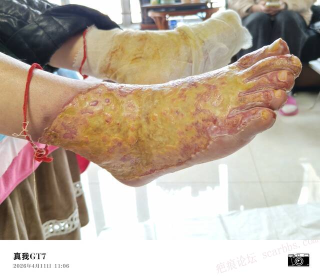 李高令2026年，接治又一个黑龙江哈尔滨，51岁，下肢瘫痪的病人… 