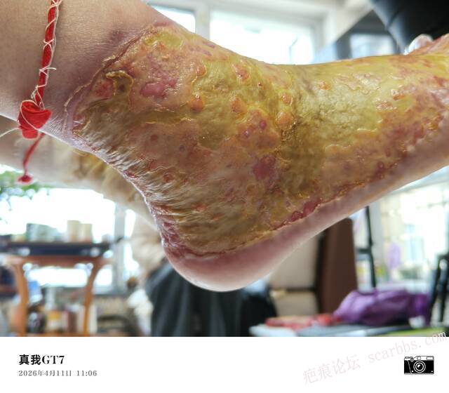 李高令2026年，接治又一个黑龙江哈尔滨，51岁，下肢瘫痪的病人… 