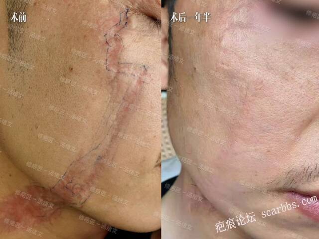 疤痕修复