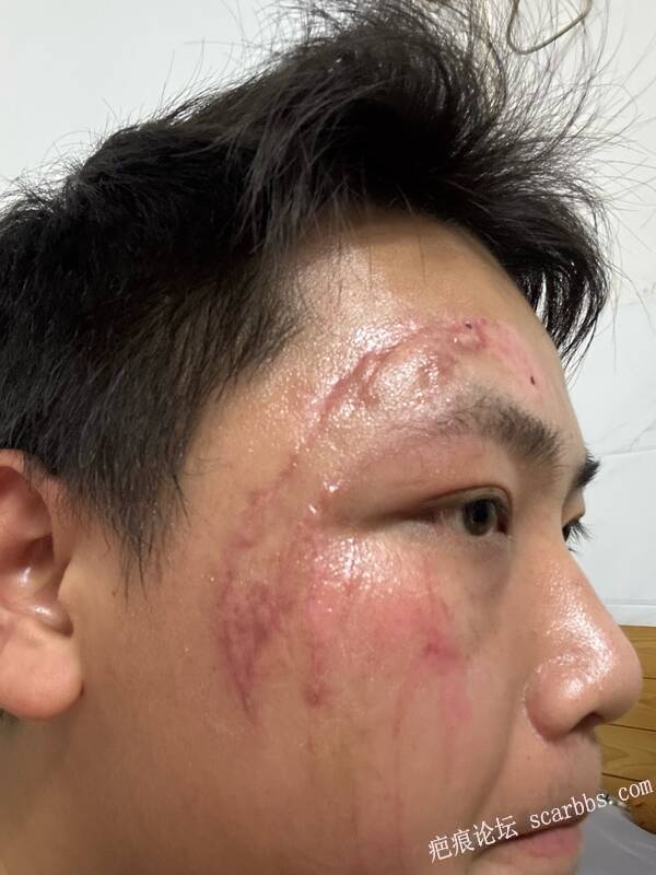 车祸外伤脸部缝合