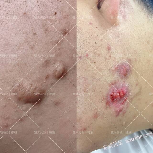 困扰了很多年的疤痕疙瘩