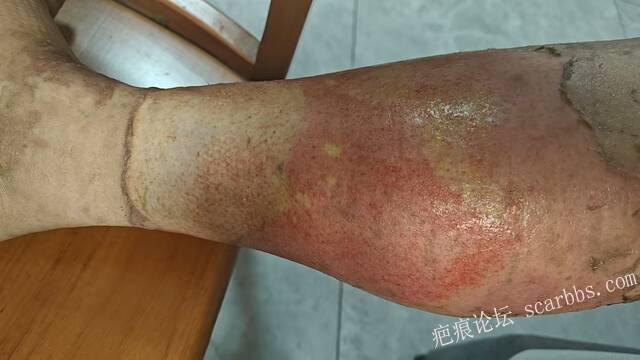 2026年，李高令接治已下植皮令的患者(荷泽) 