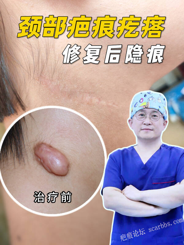 颈部疤痕疙瘩｜一个疗程修复，几乎隐形