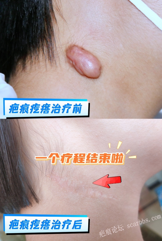 颈部疤痕疙瘩｜一个疗程修复，几乎隐形 