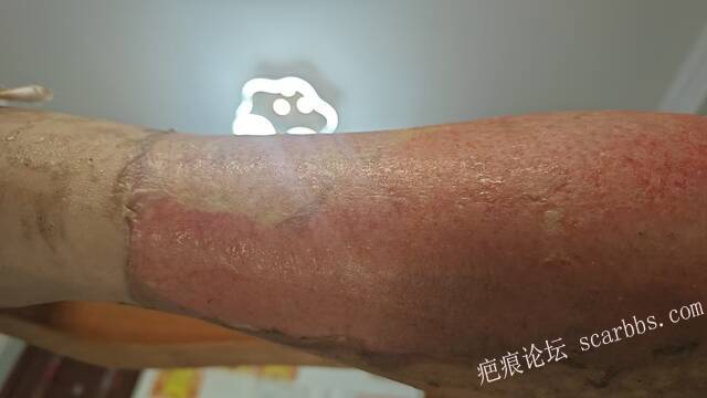2026年，李高令接治已下植皮令的患者(荷泽) 
