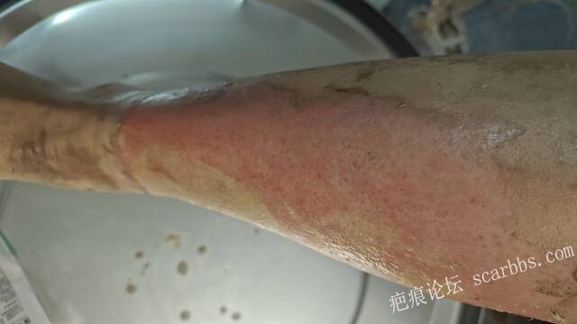2026年，李高令接治已下植皮令的患者(荷泽) 