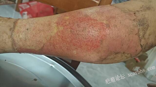 2026年，李高令接治已下植皮令的患者(荷泽) 