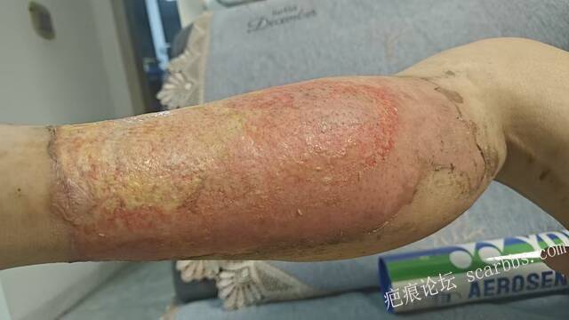 2026年，李高令接治已下植皮令的患者(荷泽) 