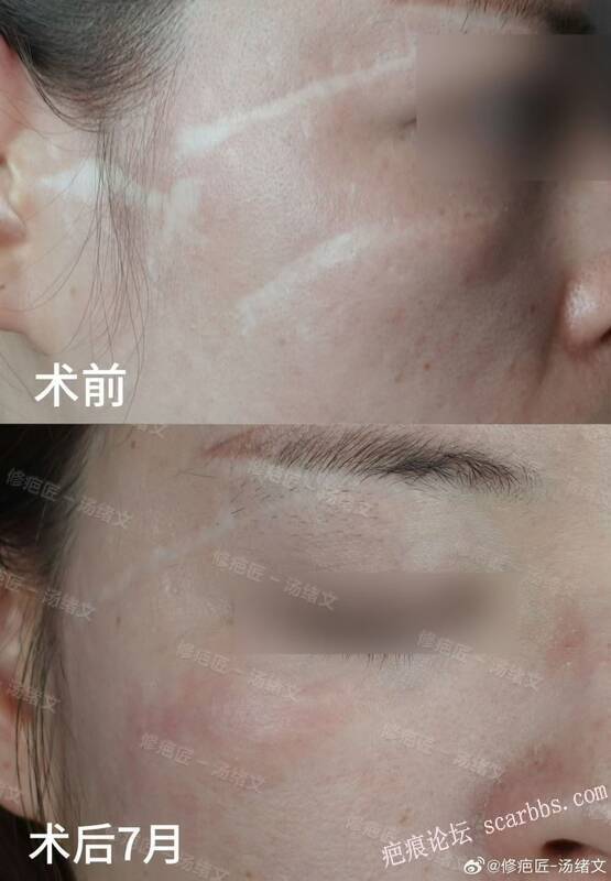 疤痕修复