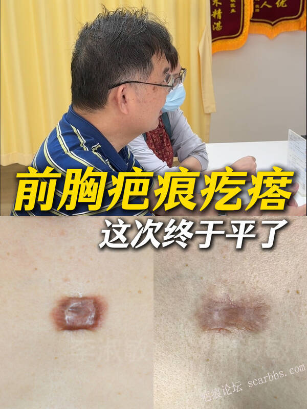 切痣导致的疤痕疙瘩，没开刀就平了