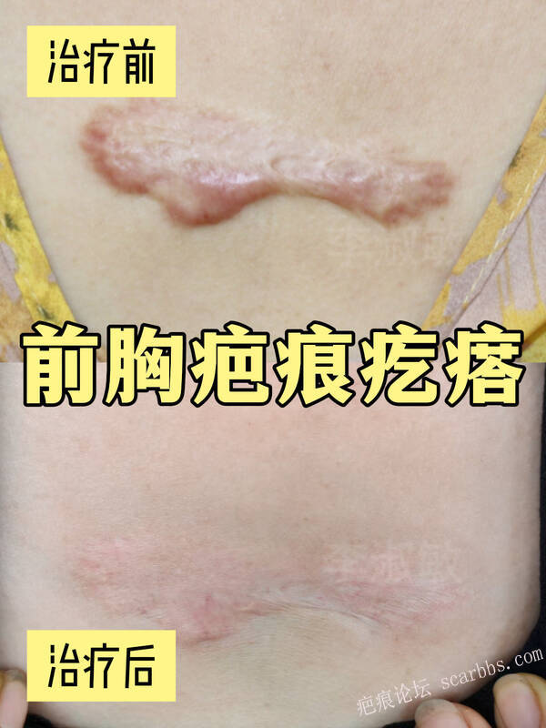 点痣留疤20年，保守治疗变平变软