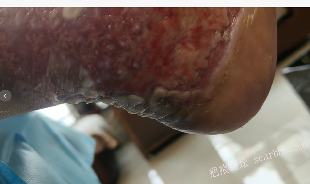 李高令2026年，接治又一个黑龙江哈尔滨，51岁，下肢瘫痪的病人… 