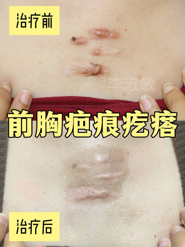 疤痕疙瘩 怀孕前治还是生完再治？
