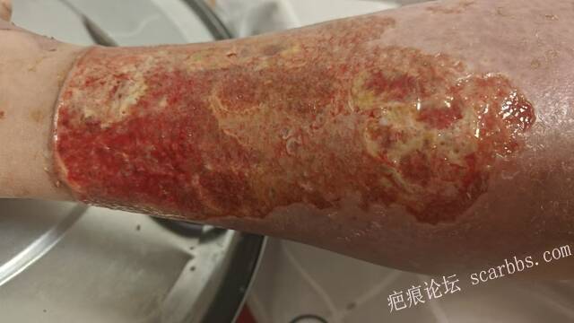 2026年，李高令接治已下植皮令的患者(荷泽) 