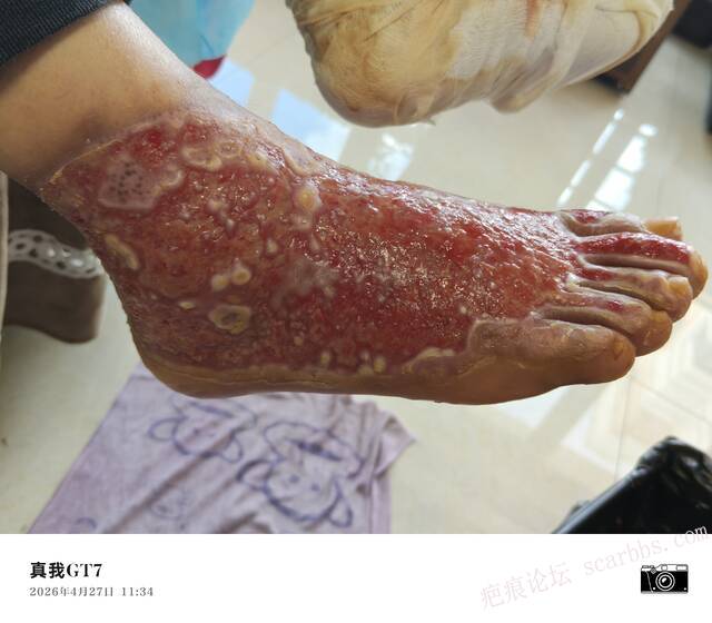 李高令2026年，接治又一个黑龙江哈尔滨，51岁，下肢瘫痪的病人… 