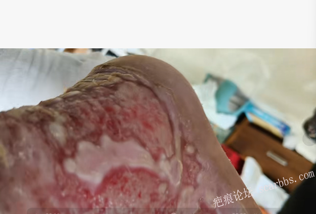 李高令2026年，接治又一个黑龙江哈尔滨，51岁，下肢瘫痪的病人… 