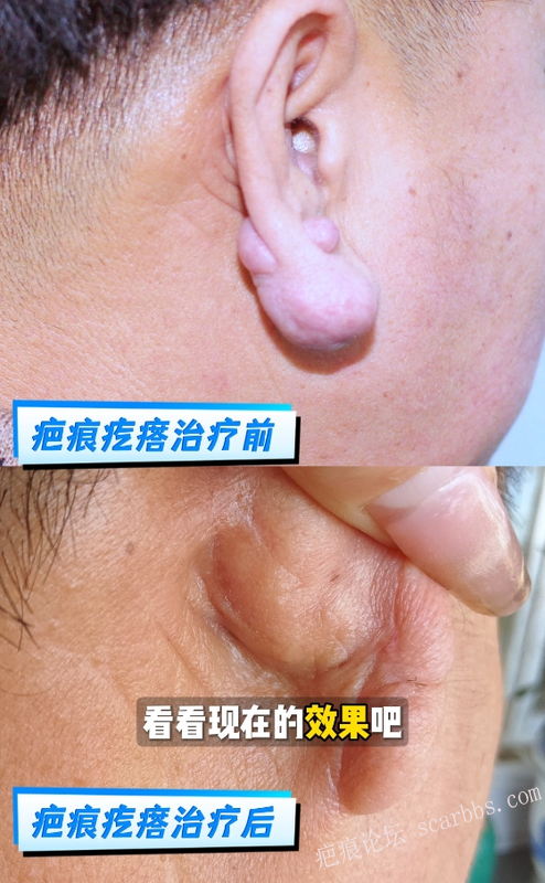 耳垂疤痕疙瘩 这样修复，告别尴尬困扰