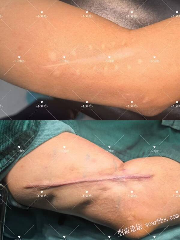 疤痕修复