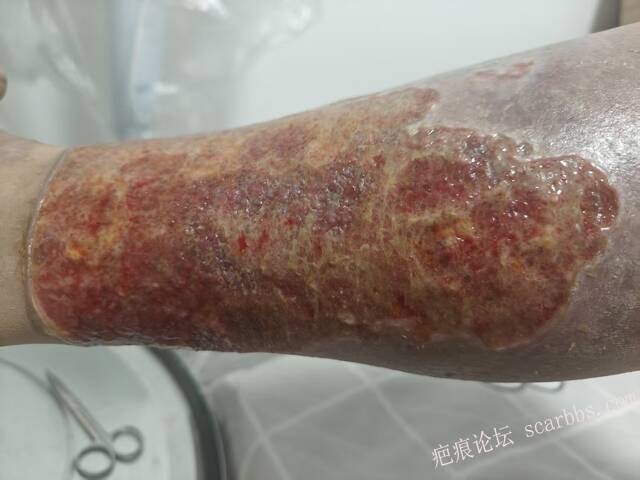 2026年，李高令接治已下植皮令的患者(荷泽) 