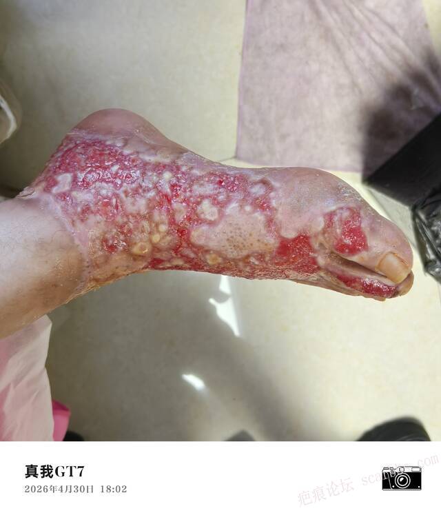 李高令2026年，接治又一个黑龙江哈尔滨，51岁，下肢瘫痪的病人… 