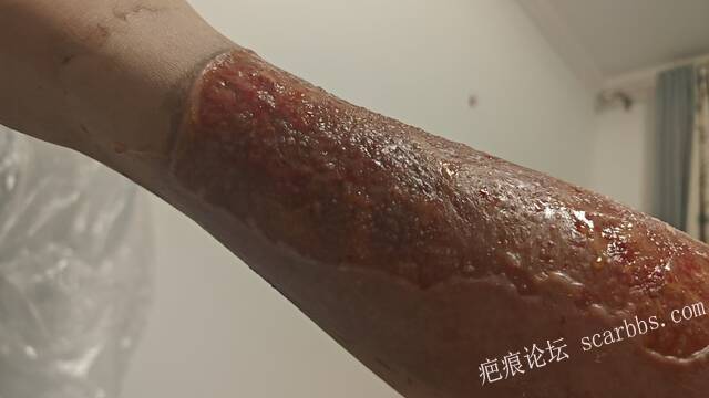 2026年，李高令接治已下植皮令的患者(荷泽) 