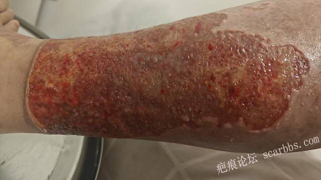 2026年，李高令接治已下植皮令的患者(荷泽) 