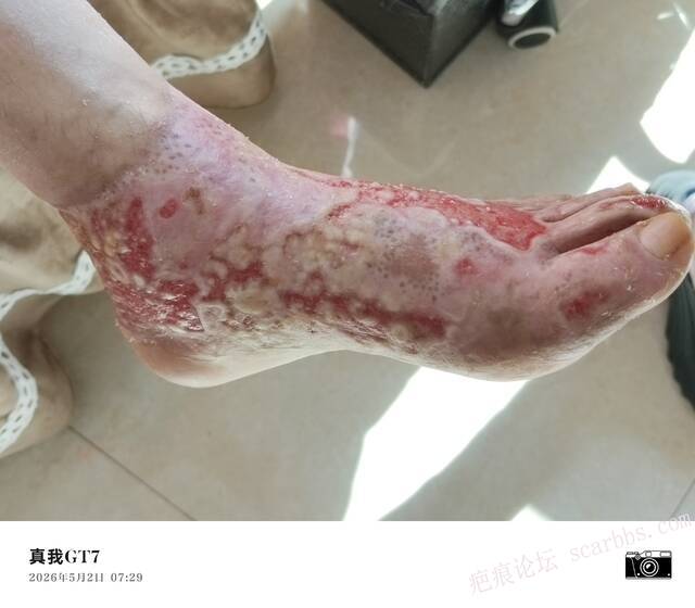 李高令2026年，接治又一个黑龙江哈尔滨，51岁，下肢瘫痪的病人… 