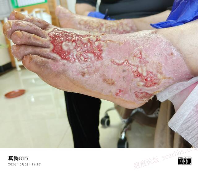 李高令2026年，接治又一个黑龙江哈尔滨，51岁，下肢瘫痪的病人… 