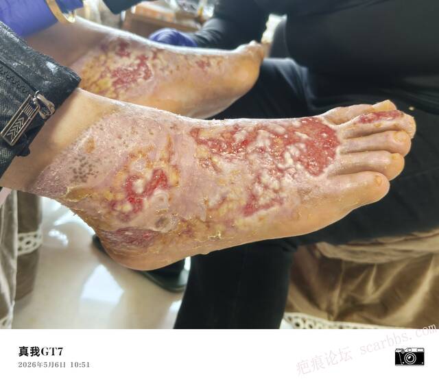 李高令2026年，接治又一个黑龙江哈尔滨，51岁，下肢瘫痪的病人… 