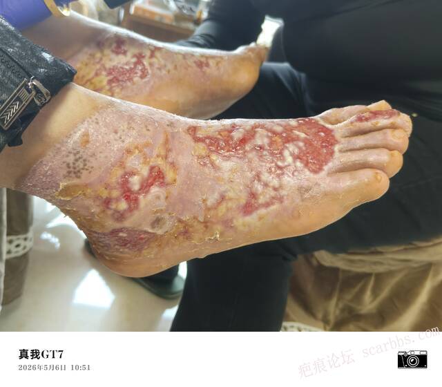 李高令2026年，接治又一个黑龙江哈尔滨，51岁，下肢瘫痪的病人… 