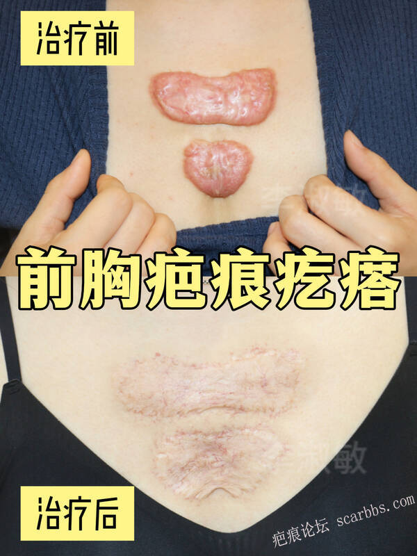 前胸疤痕疙瘩怀孕后变大，综合治疗成功上岸