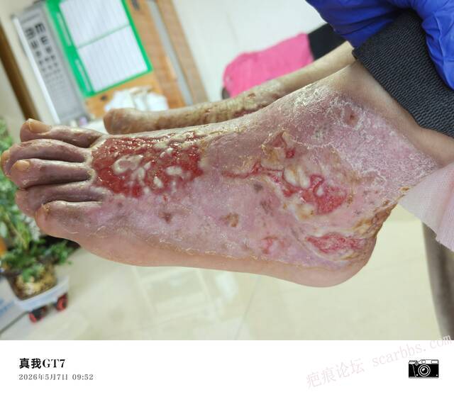 李高令2026年，接治又一个黑龙江哈尔滨，51岁，下肢瘫痪的病人… 