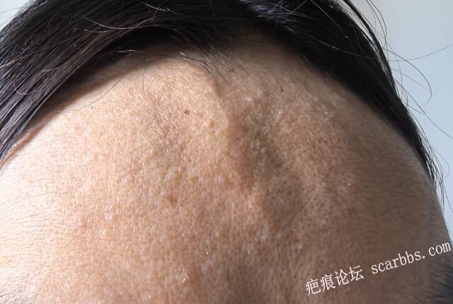 额头切缝六年，侧面光凸起明显，正面不太明显，有什么好的处理办法，需要重新切缝吗？