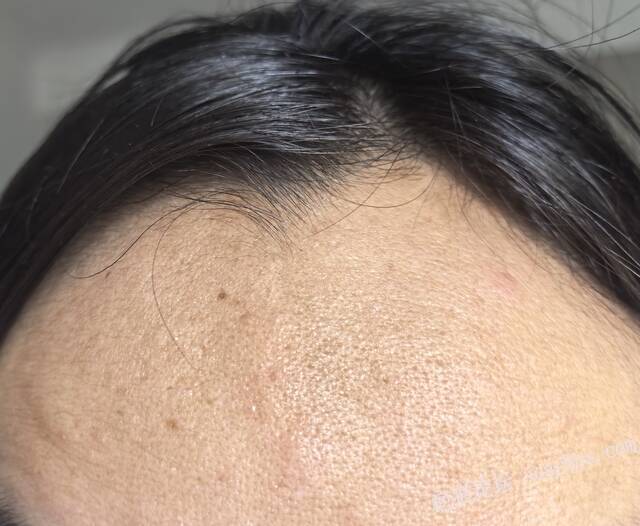 额头切缝六年，侧面光凸起明显 